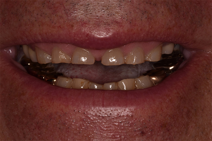 Before After Dental Photos Before and After | BayView Dental Arts